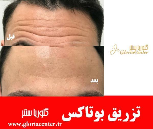 عکس بوتاکس صورت