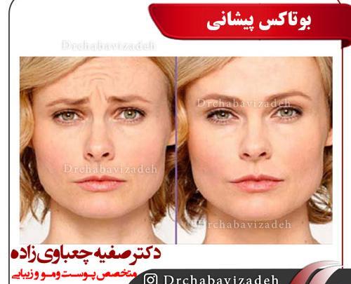 عکس بوتاکس صورت