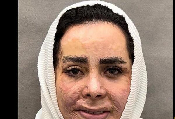 عکس زن صورت سوخته