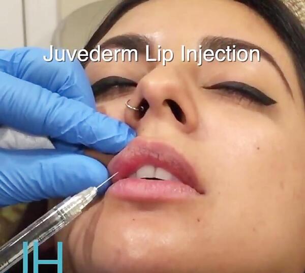 عکس کاشت خط لب