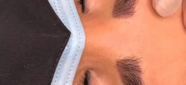 عکس کاشت خط لب