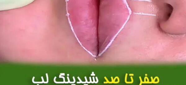 عکس کاشت خط لب