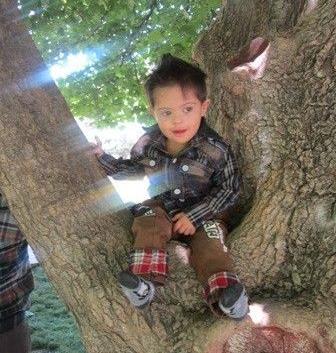 عکس نوزاد سندرم داون