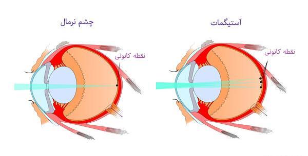 عکس چشم آستیگمات