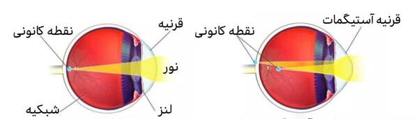 عکس چشم آستیگمات