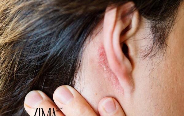 عکس اولیه شپش سر