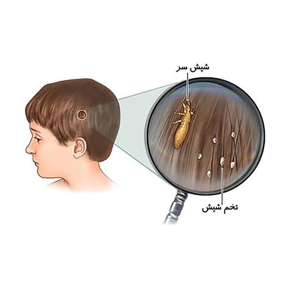 عکس پودر شپش