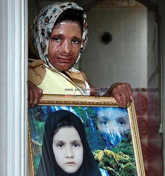 عکس پسر بچه سوخته