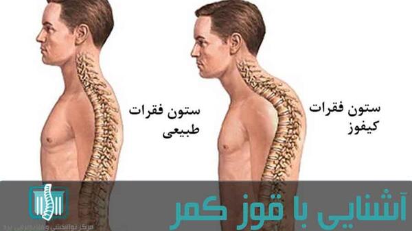 عکس کبودی پشت کمر