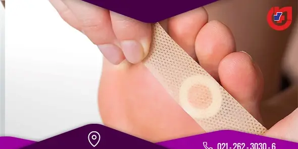 عکس میخچه نی نی سایت