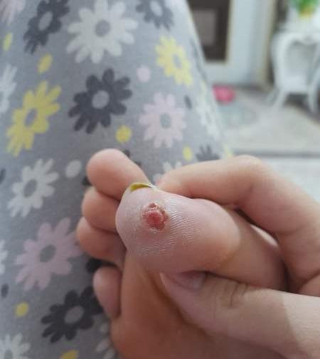 عکس میخچه نی نی سایت