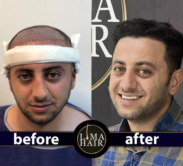 عکس ییلماز قبل از عمل