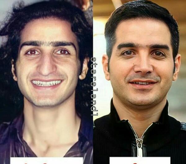 عکس ییلماز قبل از عمل
