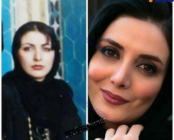 عکس رویا میرعلمی قبل از عمل