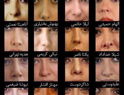 عکس رویا میرعلمی قبل از عمل