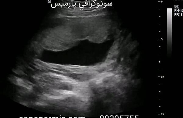 عکس جنین صد روزه