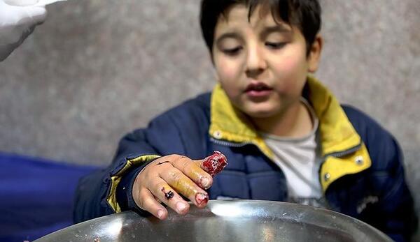 عکس سوختگی چهارشنبه سوری