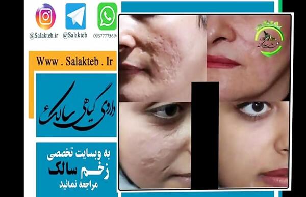 عکس جای نیش پشه سالک نی نی سایت