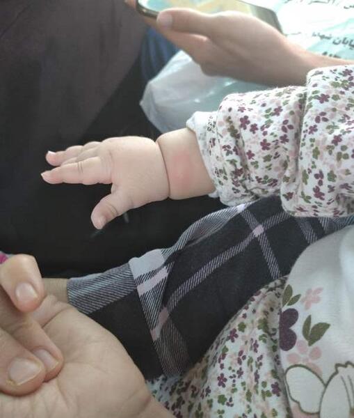 عکس جای نیش پشه سالک نی نی سایت