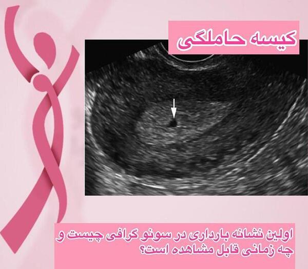 عکس اولین سونوگرافی بارداری نی نی سایت