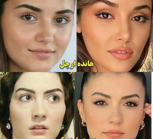 عکس ییلدیز قبل از عمل
