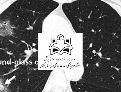 عکس اسکن ریه درگیر کرونا