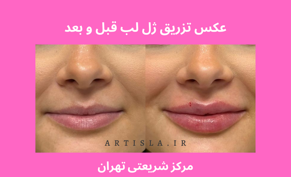 عکس ژله لب