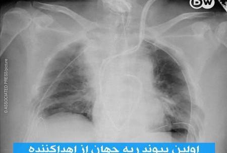 عکس ریه کرونایی ترکیه