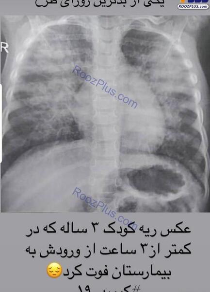 عکس ریه کرونایی ترکیه