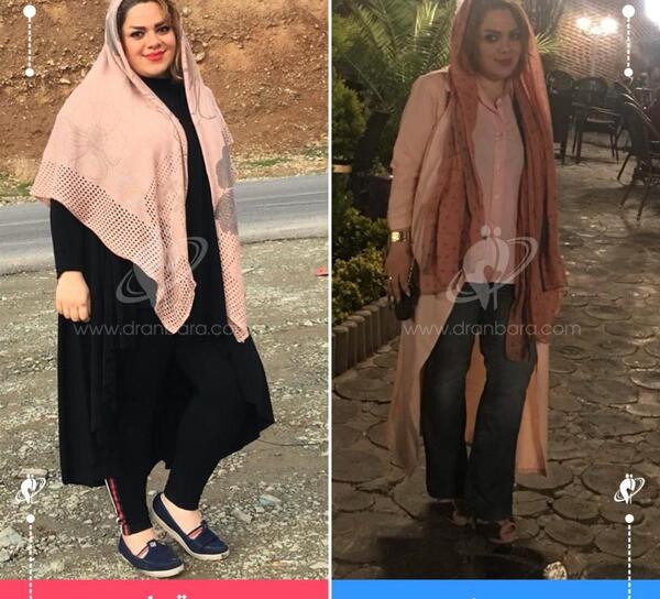 عکس قبل جراحی سحر تبر