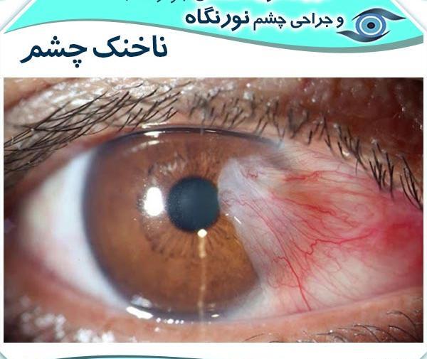 عکس چشم یک