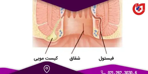 عکس فیستول