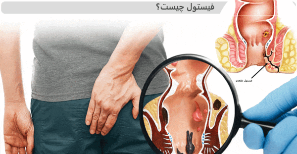 عکس فیستول