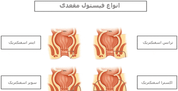 عکس فیستول