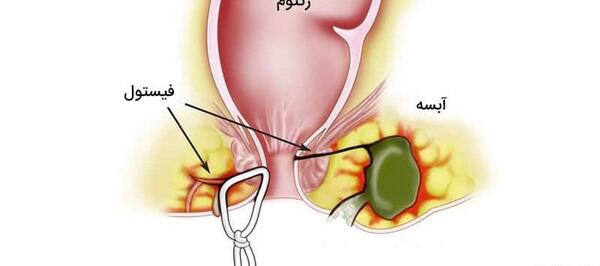 عکس فیستول