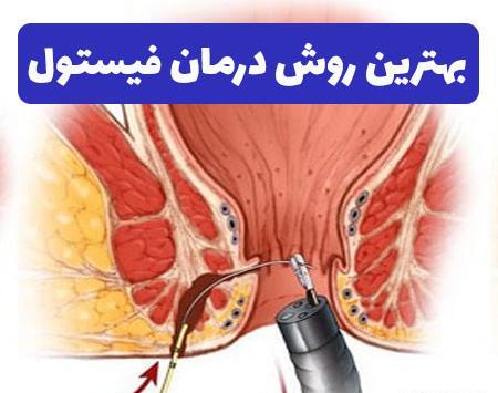عکس فیستول