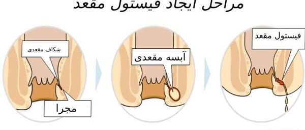 عکس فیستول