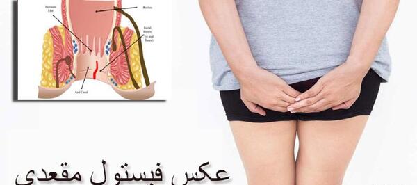 عکس فیستول