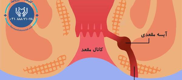 عکس فیستول