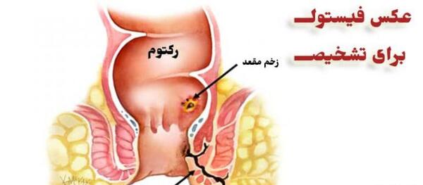 عکس فیستول