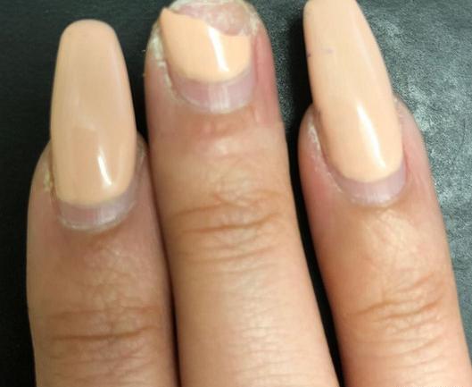 عکس کاشت ناخن قارچ گرفته