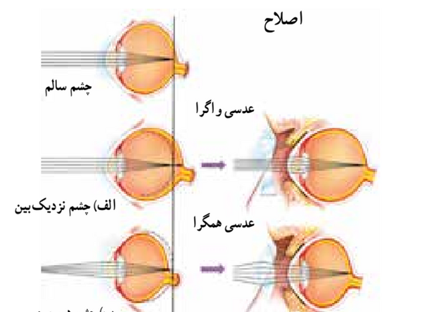 عکس چشم نزدیک بین