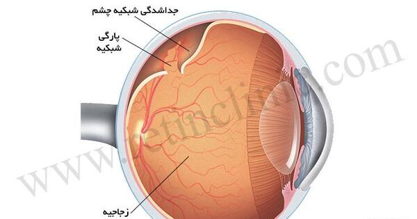 عکس چشم نزدیک بین