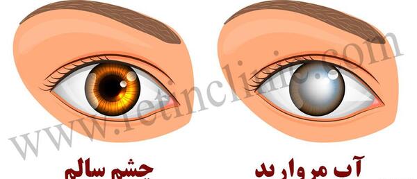 عکس چشم نزدیک بین