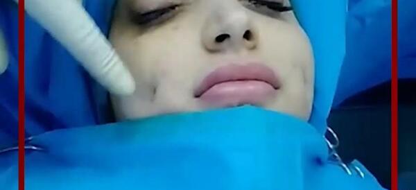 عکس کاشت چال گونه
