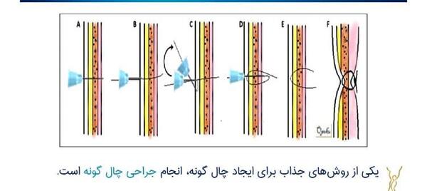 عکس کاشت چال گونه