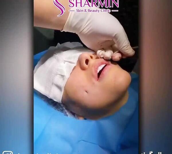 عکس کاشت چال گونه