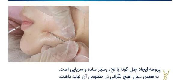 عکس کاشت چال گونه