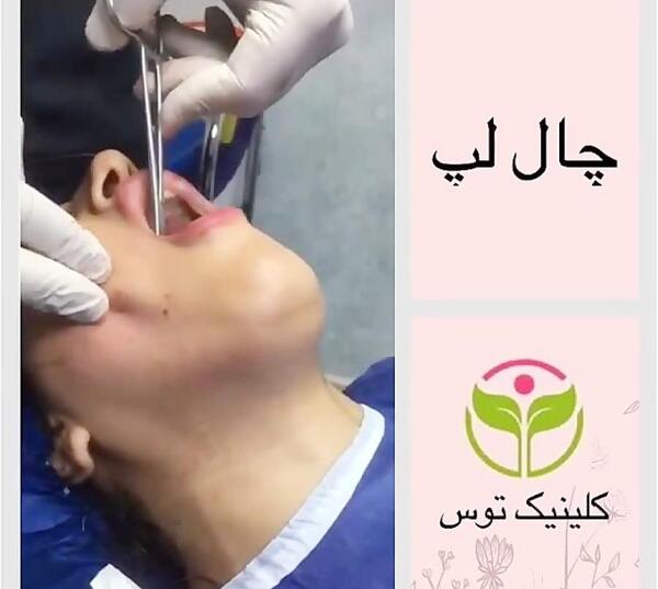 عکس کاشت چال گونه