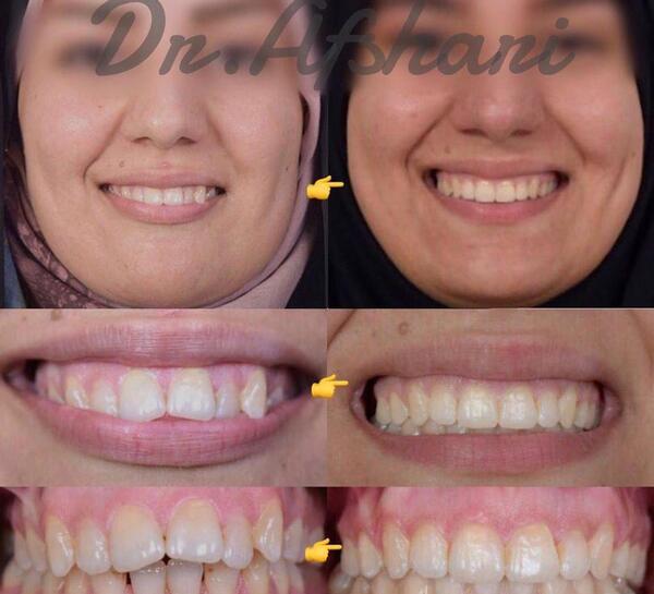 عکس قبل و بعد ارتودنسی